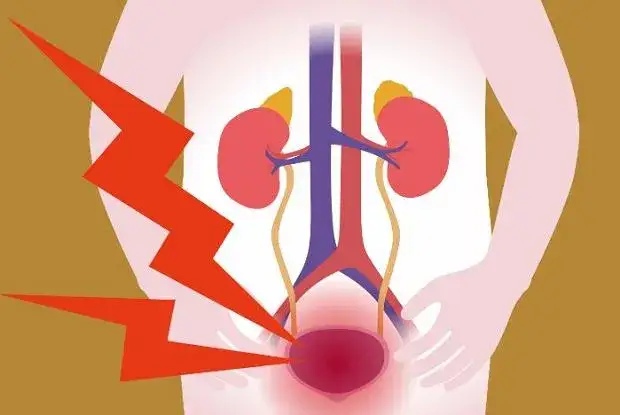 Nerwica pęcherza: objawy, przyczyny i skuteczne sposoby leczenia