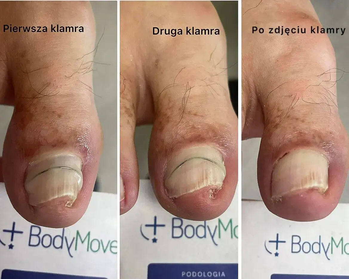 Leczenie wrastającego paznokcia: Od domu po podologa. Co wybrać?