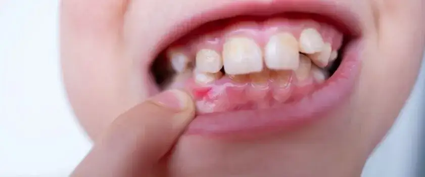 Skuteczne metody na zapalenie dziąseł u dziecka - uniknij bólu