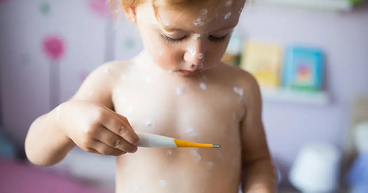 Jakie leki na ospę wietrzną skutecznie łagodzą objawy choroby?