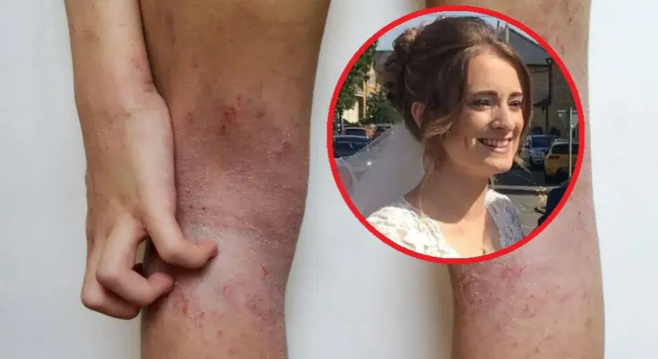 Nerki objawy choroby - poznaj niepokojące symptomy i ich skutki