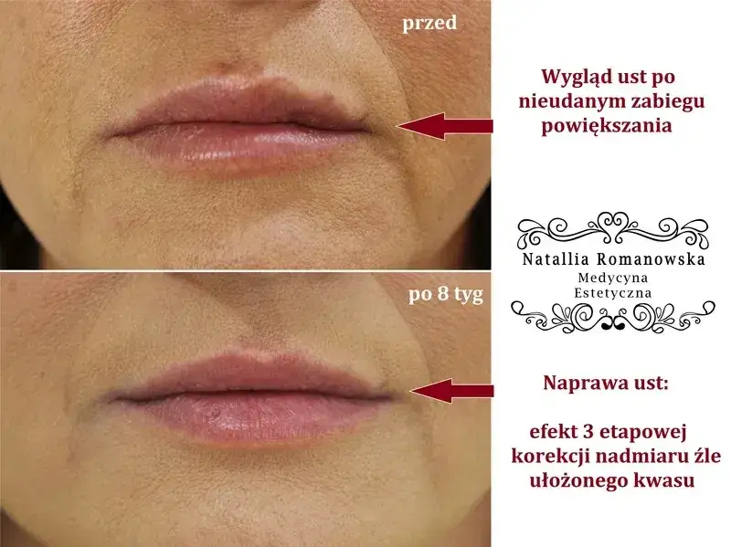 Kiedy można się całować po powiększaniu ust? Uniknij ryzyka infekcji