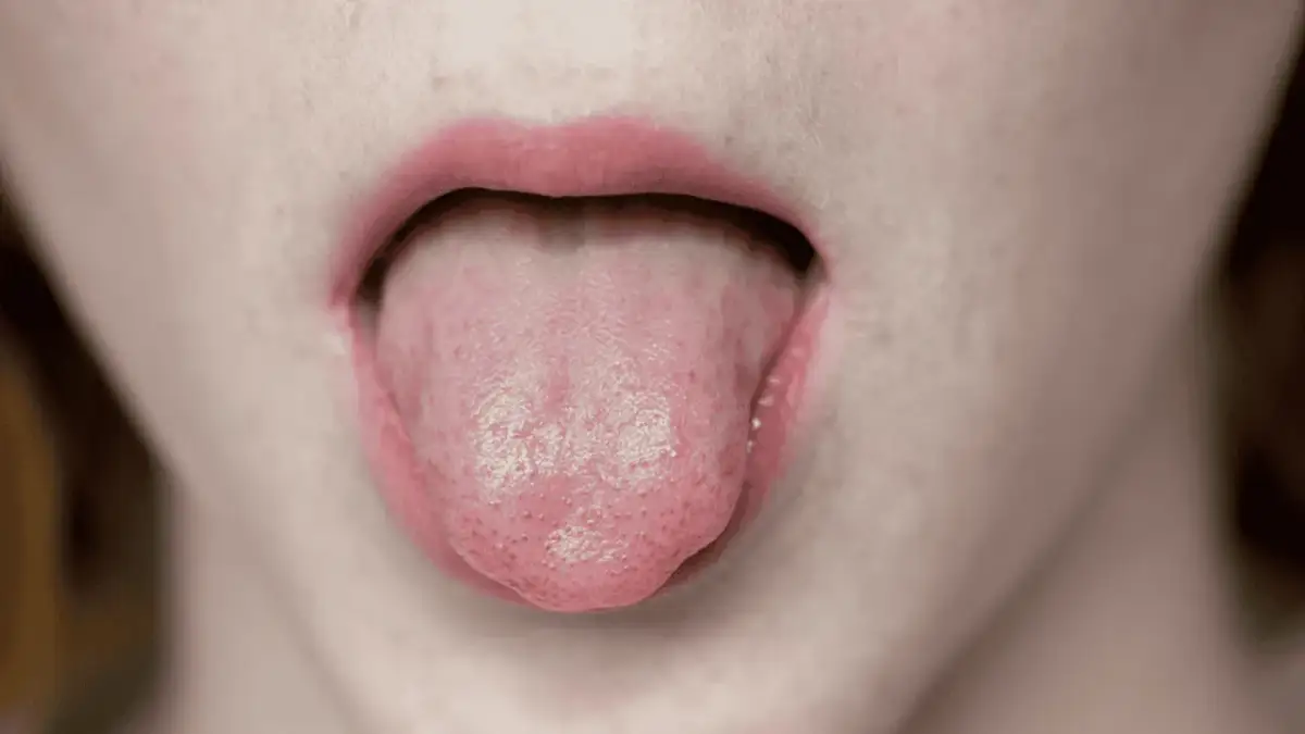 Usta z wyciągniętym językiem, na którym widać drobne nierówności, jakby mały bąbel pod językiem.