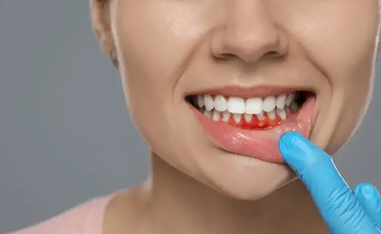 Wzmocnienie dziąseł: dieta, higiena i apteka kompleksowy poradnik