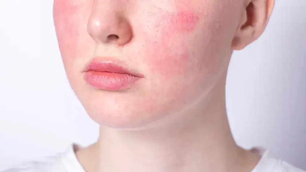 Jak rozpoznać cerę wrażliwą? Objawy i cechy, które musisz znać