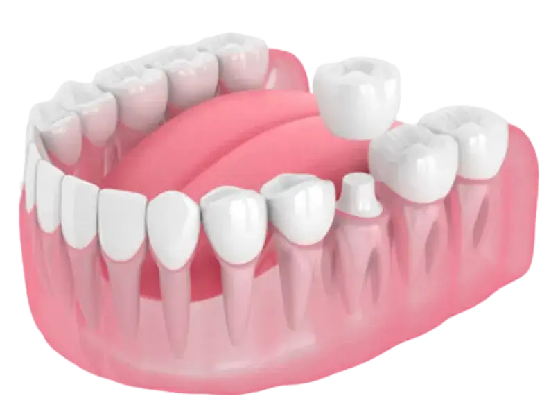 Całkowity koszt korony na jedynce: Ile naprawdę zapłacisz?