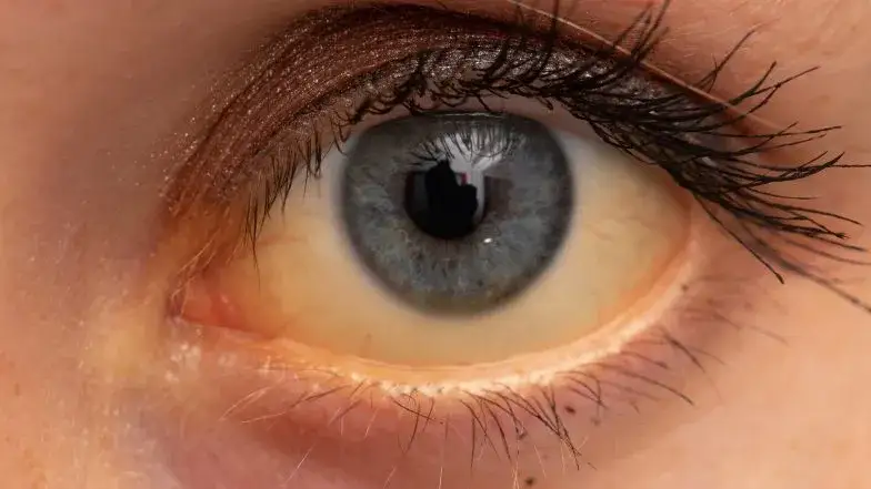 Podwyższona bilirubina: Czy to powód do niepokoju? Objawy i leczenie.