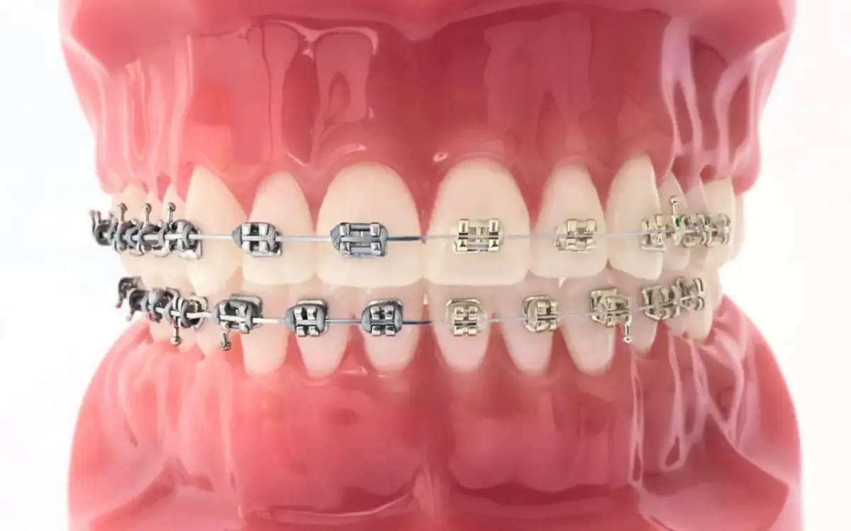 Czy aparat na zęby boli? Jak uniknąć bólu i dyskomfortu podczas noszenia