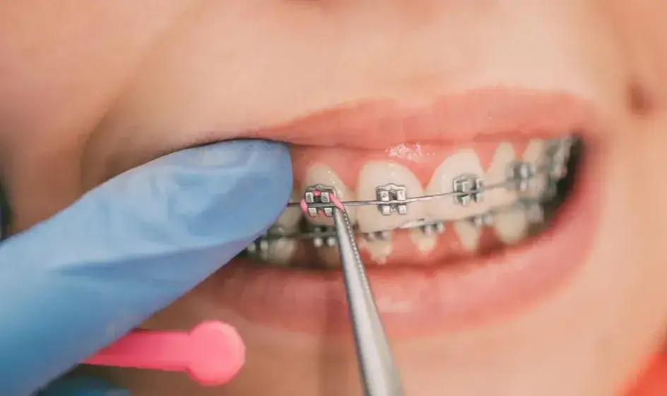 Ile kosztuje aparat ortodontyczny? Sprawdź ceny i porównania