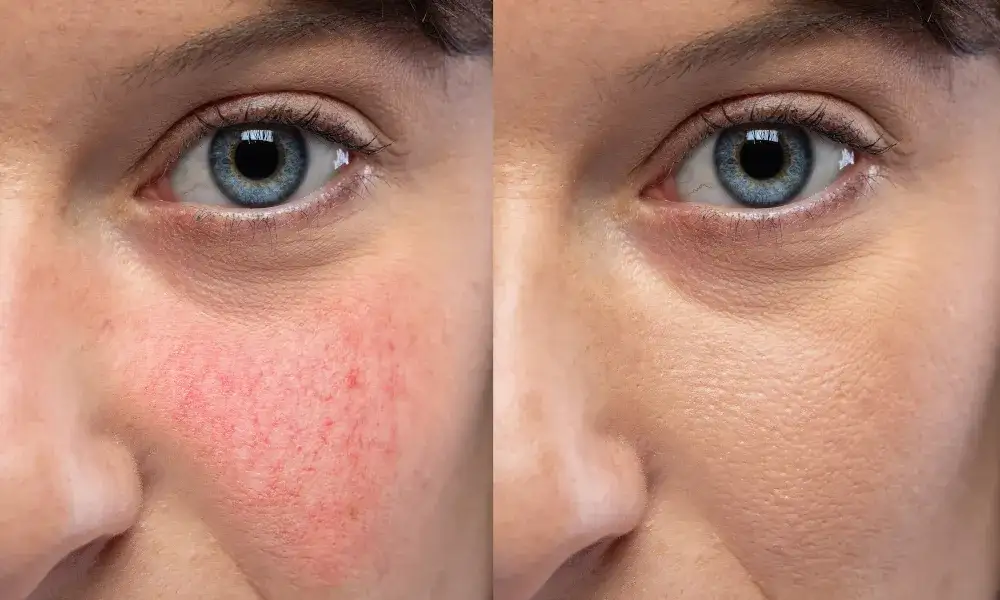 Jak wygląda zapchana cera i jak skutecznie ją wyleczyć