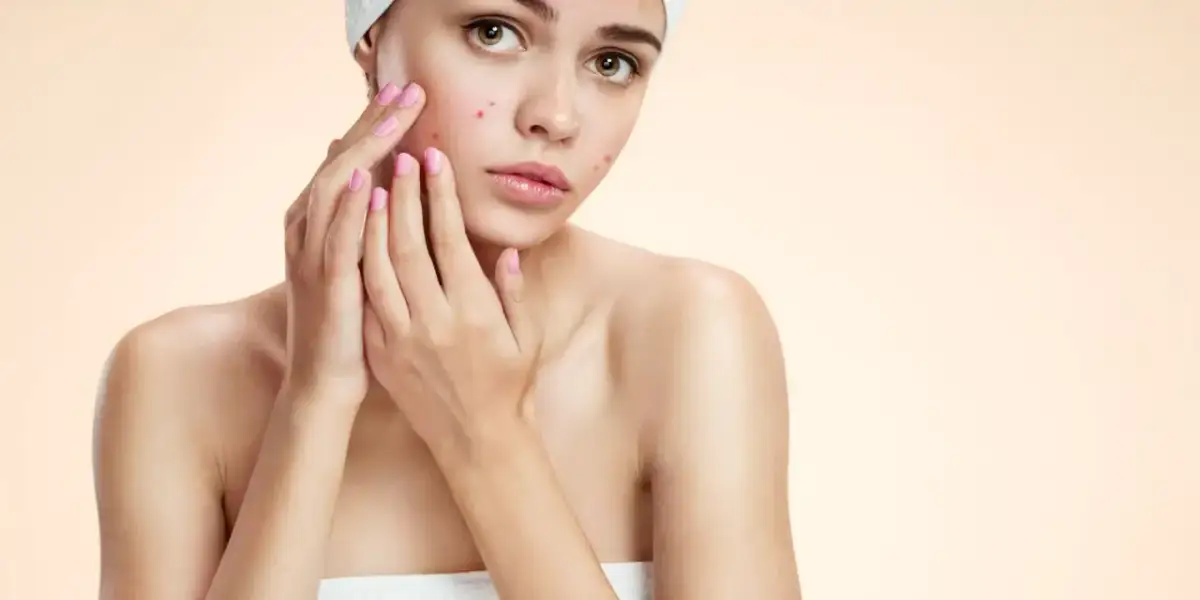 Młoda kobieta z pryszczami na czole i policzku, dotykająca twarzy.