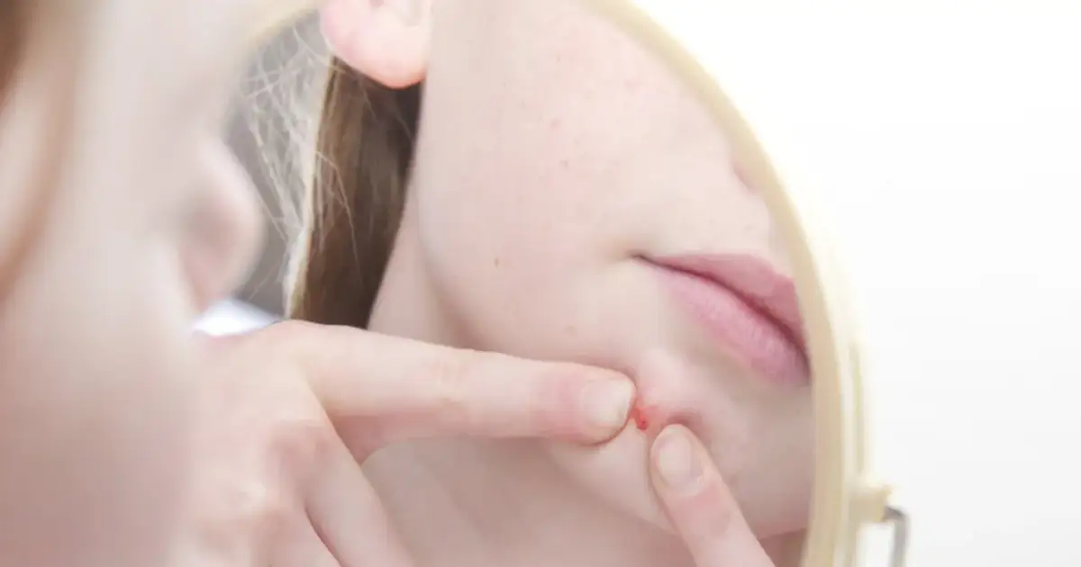 Pryszcze u nastolatków: Co działa? Kompletny przewodnik po trądziku