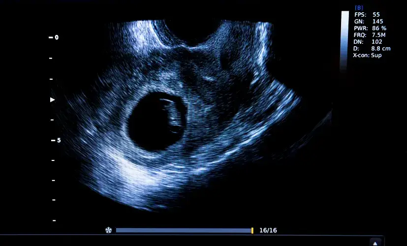 USG w 5. tygodniu ciąży: Co zobaczysz i kiedy bez obaw?