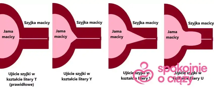 Skracanie szyjki macicy przed porodem: objawy, tempo, kiedy do lekarza?