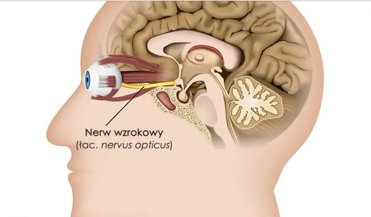 Zapalenie nerwu wzrokowego: Jakie leki? Klucz do wzroku i SM