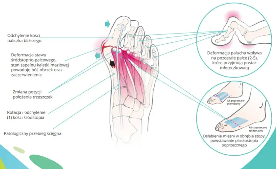Jak dbać o stopę po operacji haluksa, aby uniknąć bólu i komplikacji