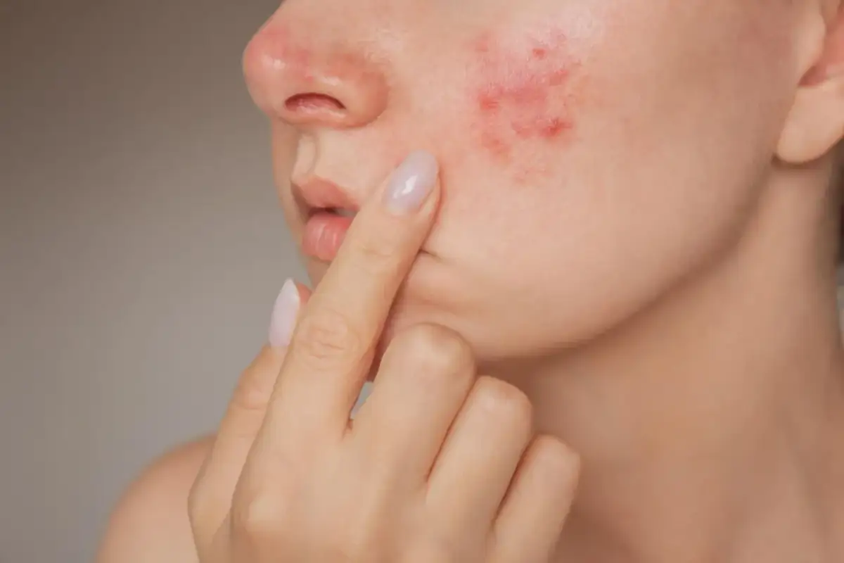 Jak nie mieć pryszczy? Co naprawdę działa na czystą cerę!
