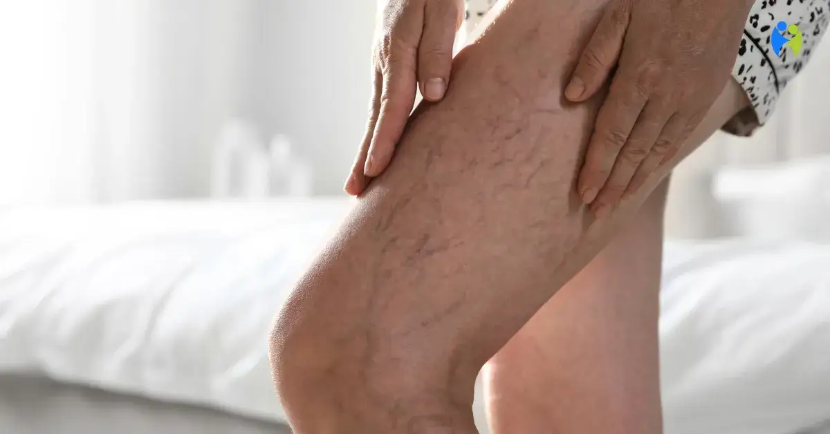 Żylaki w ciąży: Czy są groźne? Fakty, mity i bezpieczna profilaktyka