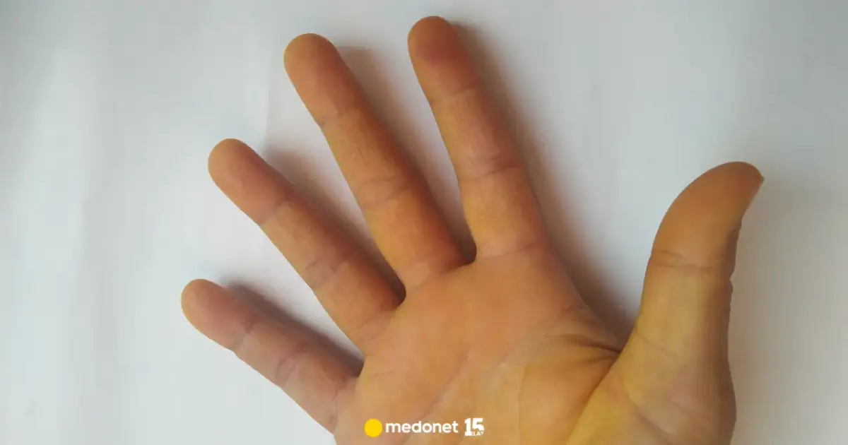 Żółty odcień skóry dłoni i stóp: Czy to karotenemia, czy poważna choroba?