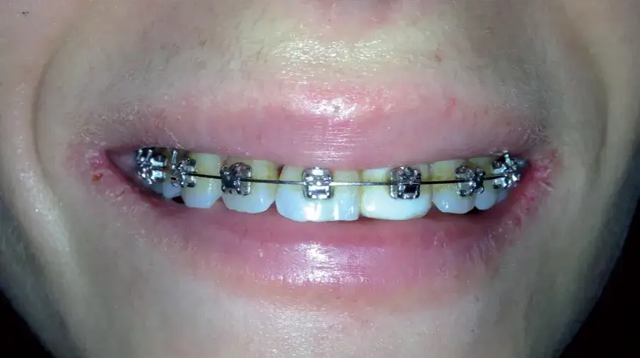 Objawy alergii na nikiel w ustach: Rozpoznaj i lecz skutecznie