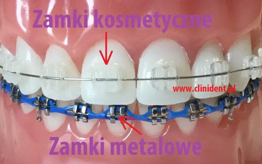 Aparat na zęby: zobacz, jak wygląda! Od metalu po niewidoczne