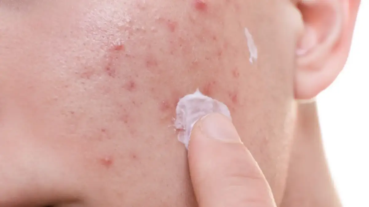 Palec nakłada krem na skórę z widocznymi stany zapalne na twarzy.