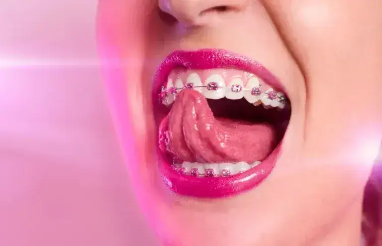 Aparaty na zęby: Jaki wybrać? Przewodnik po typach i cenach