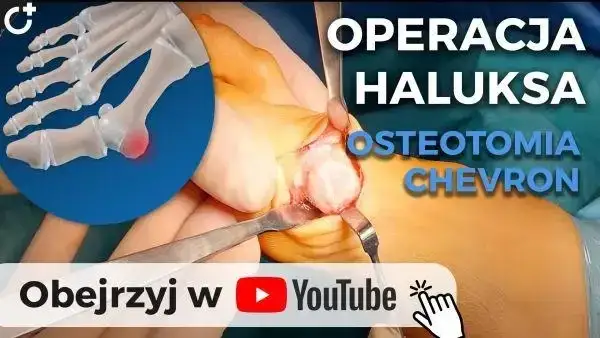 Operacja haluksów: Wybierz klinikę i metodę. Poradnik.