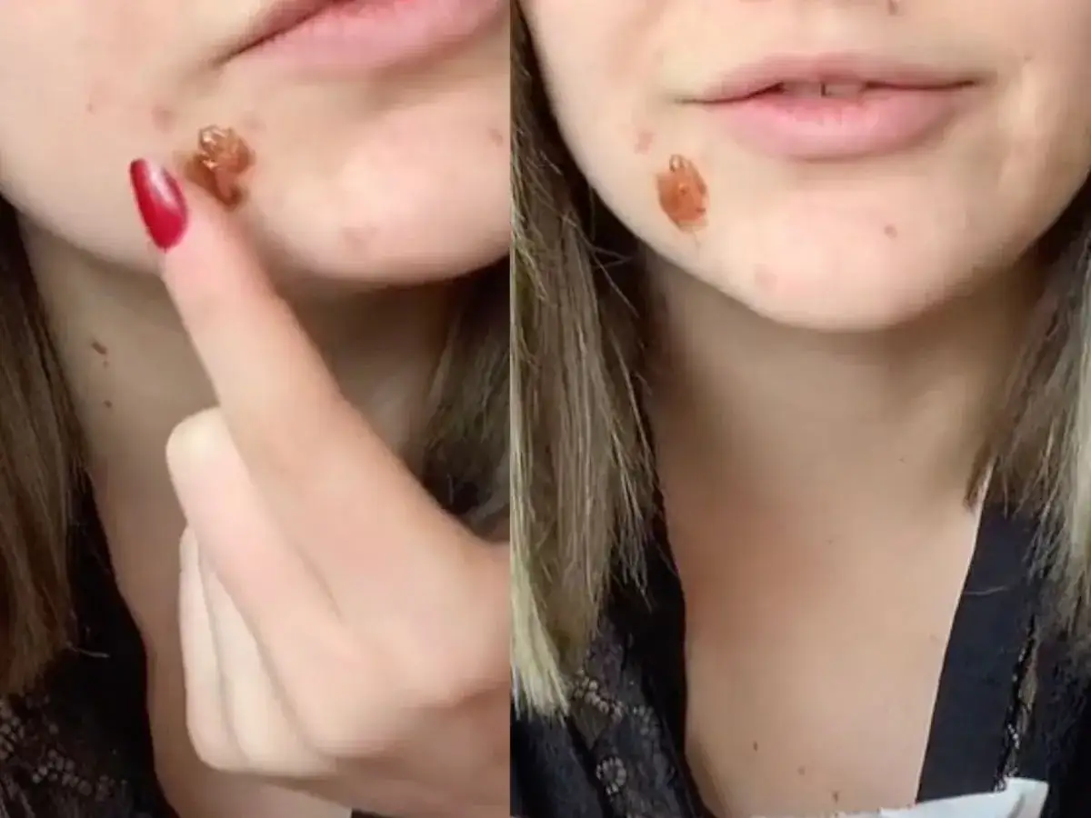 Zasuszyć pryszcza: apteka, dom i błędy, które szkodzą skórze