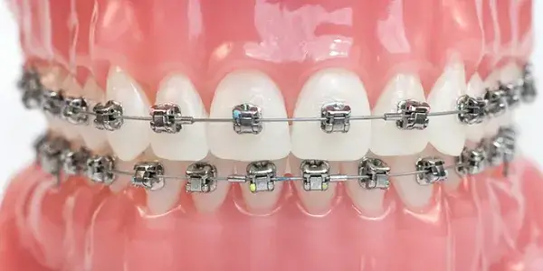 Aparat ortodontyczny: jak wybrać idealny? Rodzaje, koszty, porady