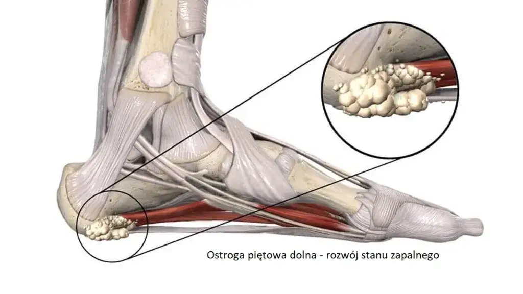 Ostroga piętowa: do jakiego lekarza i jak leczyć?