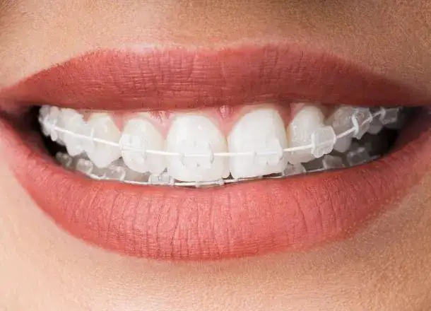 Aparat na jeden łuk: Czy to możliwe i bezpieczne? Diagnoza ortodonty