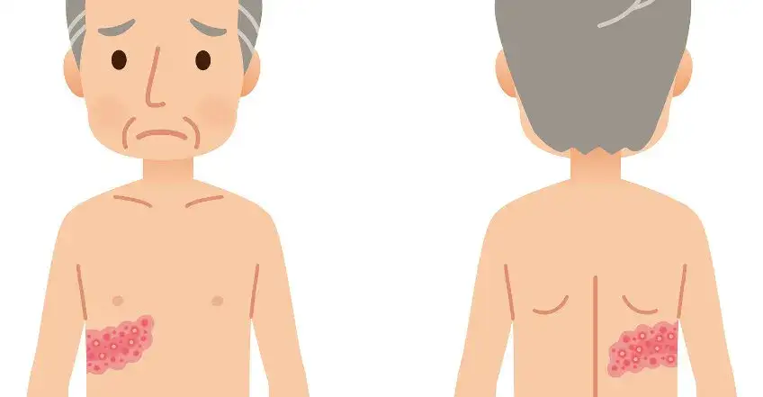 Leczenie półpaśca: Jak długo trwa? Co musisz wiedzieć o terapii?