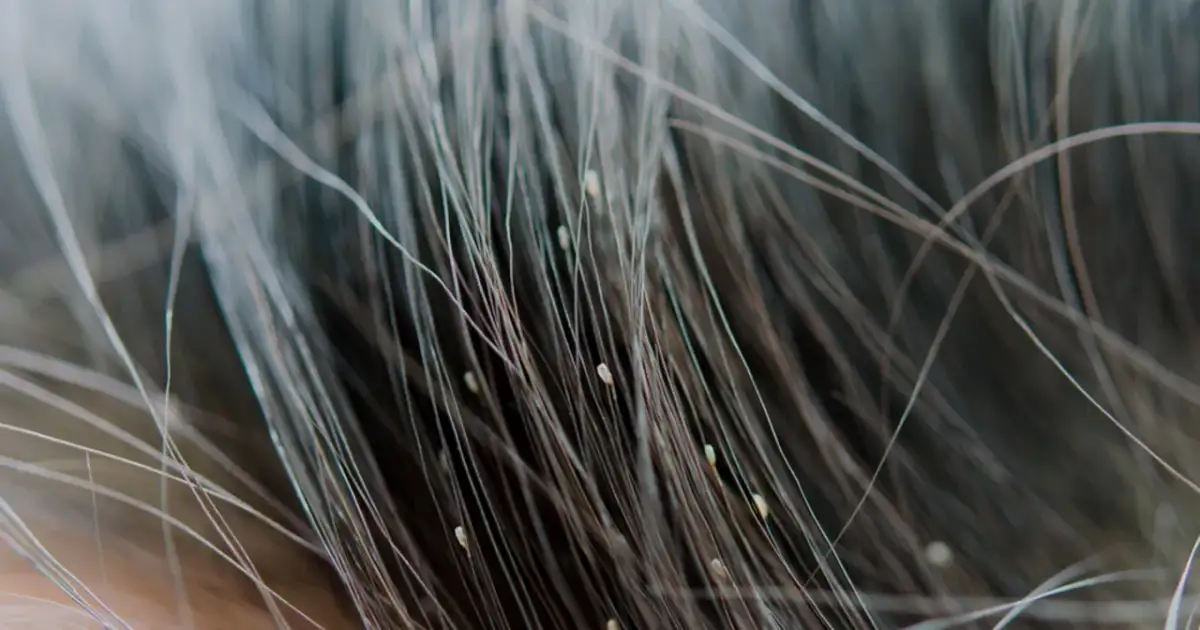 Wszawica u dziecka: Kiedy do szkoły? Już następnego dnia!