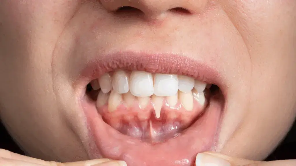 Przeszczep dziąsła: Czy warto? Koszty, korzyści i rekonwalescencja