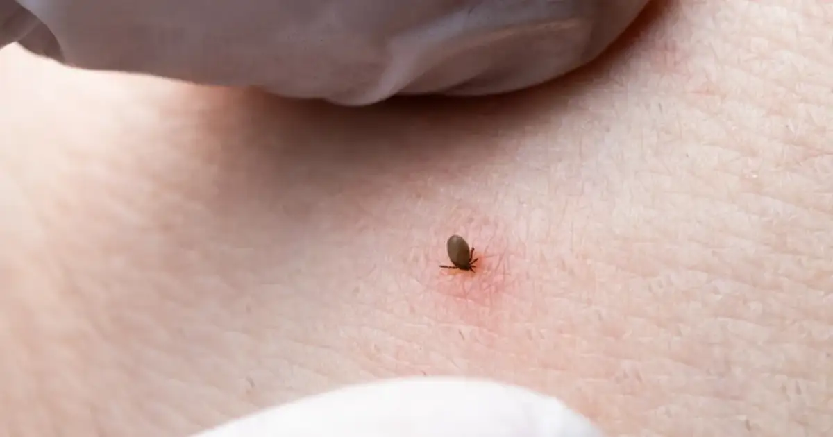 Kleszcz – kiedy do lekarza? Objawy, które mogą zagrażać zdrowiu