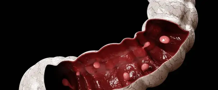Polip w jelitach objawy – jak je rozpoznać i kiedy iść do lekarza
