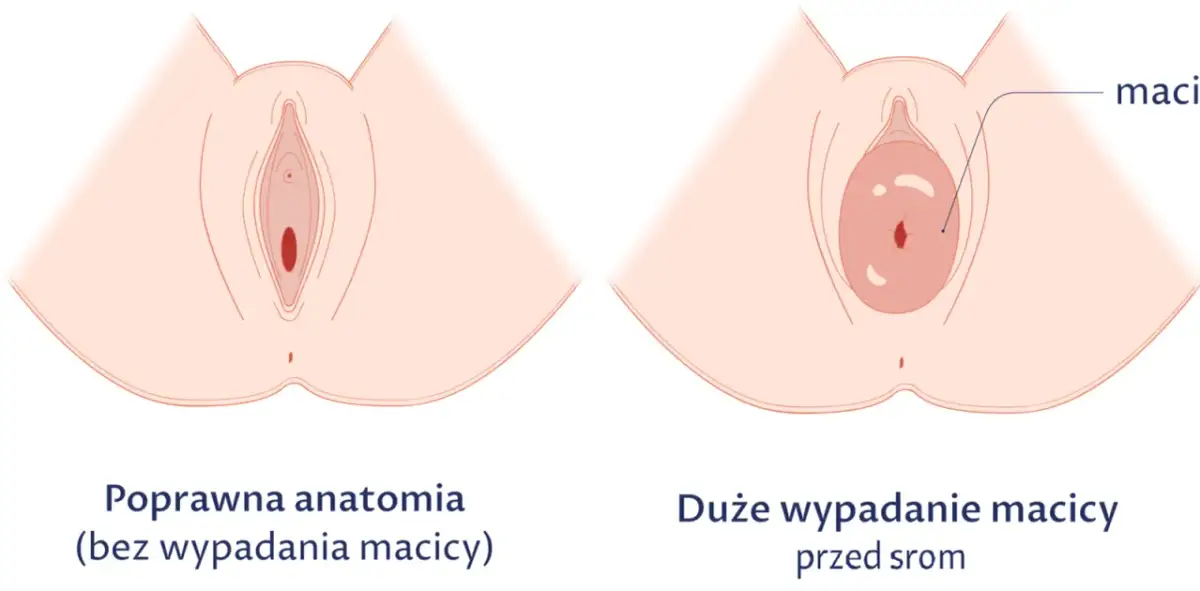 Obniżona macica po porodzie: 7 objawów, które musisz znać