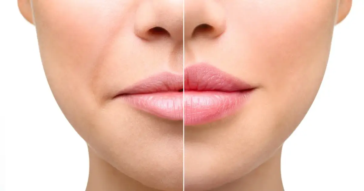 Powiększanie ust: Ból? Nie, jeśli wiesz, jak się przygotować!