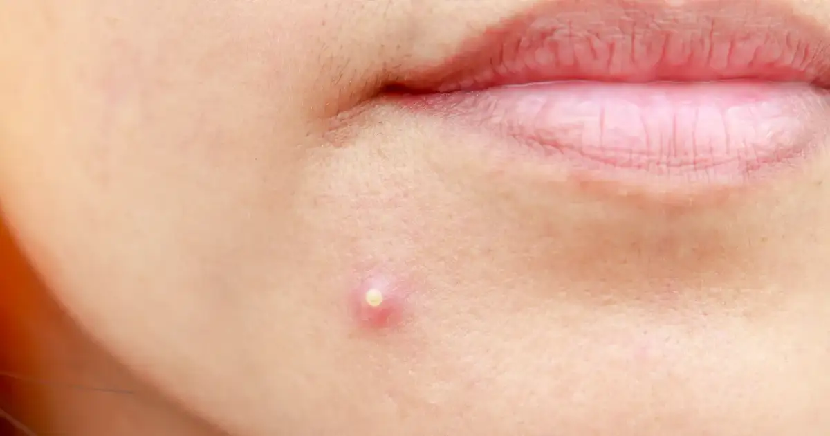 Pryszcze: Co naprawdę pomaga? Od domowych po dermatologa