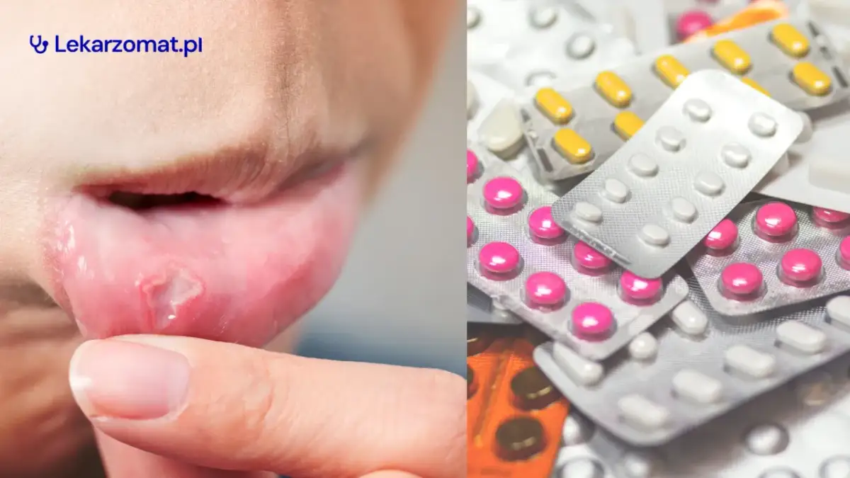 Afty na dziąśle: Szybka ulga i leczenie. Co naprawdę działa?