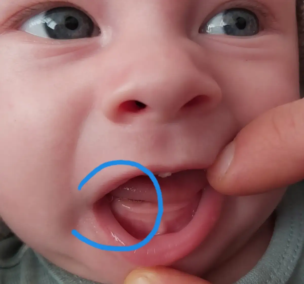 Jak wyglądają dziąsła przy ząbkowaniu – zdjęcia i objawy, które musisz znać