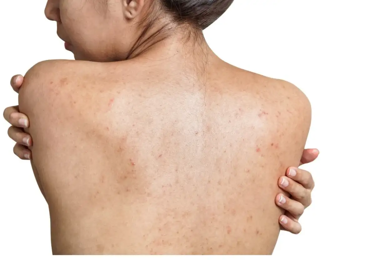 Trądzik na plecach? Skuteczne sposoby na gładką skórę bez krost!