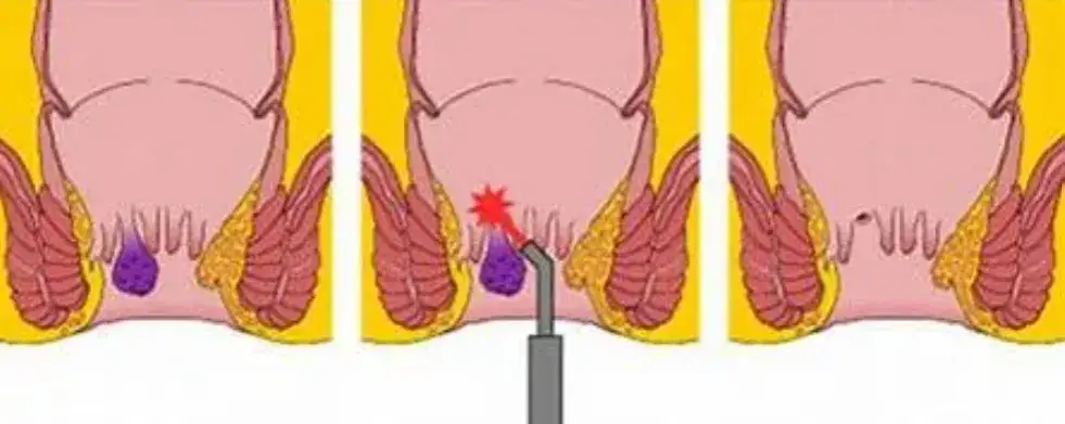 Jak skutecznie leczyć szczelinę odbytu? Od leków po Botoks