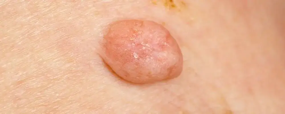 HPV: Dermatolog czy urolog? Który specjalista pomoże w infekcji?