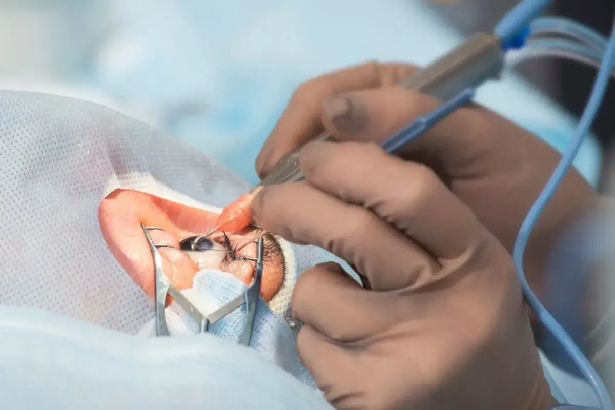 Chirurg w rękawiczkach wykonuje operację oka przy użyciu narzędzi.