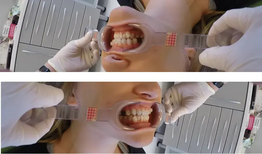 Jak bezpiecznie przekręcać aparat Hassa i uniknąć bólu podczas używania