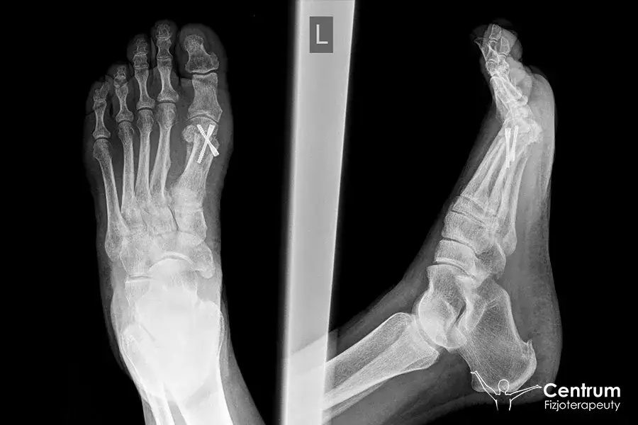 Powrót do chodzenia po operacji haluksa: Twój przewodnik krok po kroku