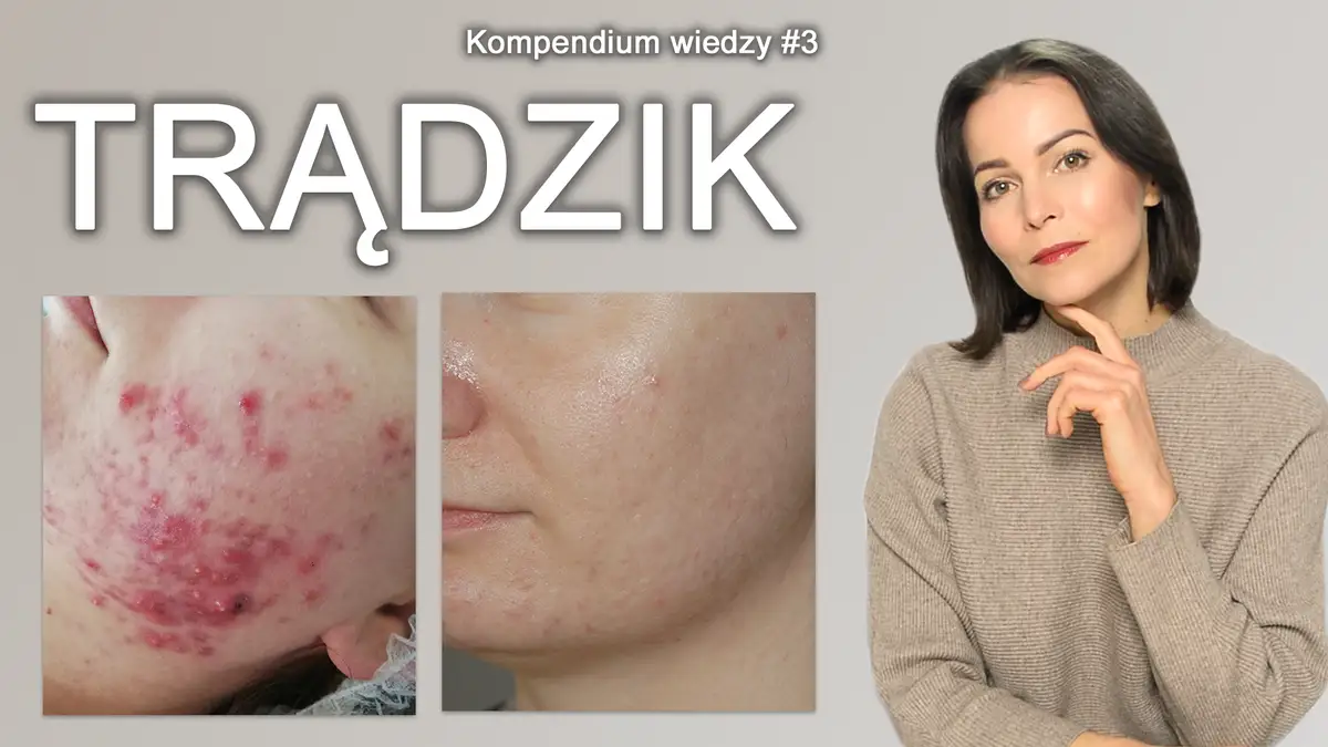 Pryszcze? Poznaj sekrety czystej cery i zapomnij o problemie!