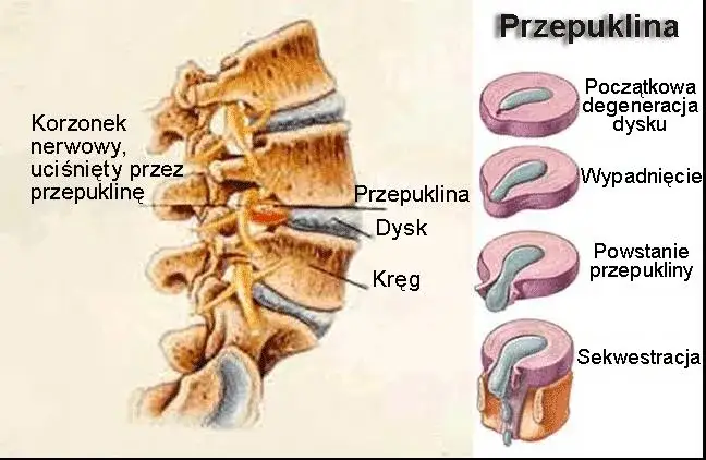 Przepuklina lędźwiowa: Jakie ćwiczenia pomogą, a czego unikać?